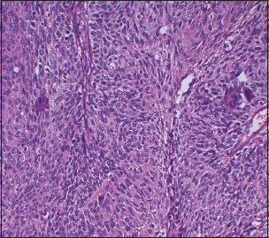 | Figure 4 Biopsy from the mass lesion showing fragmented lacrimal sac ...