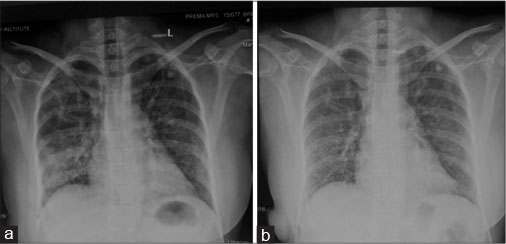 | Figure 1 Pretreatment X-ray showing interstitial infiltrates ...