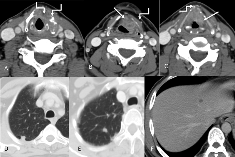 | Figure 7: Subglottic involvement. Axial and coronal CT images (A and ...